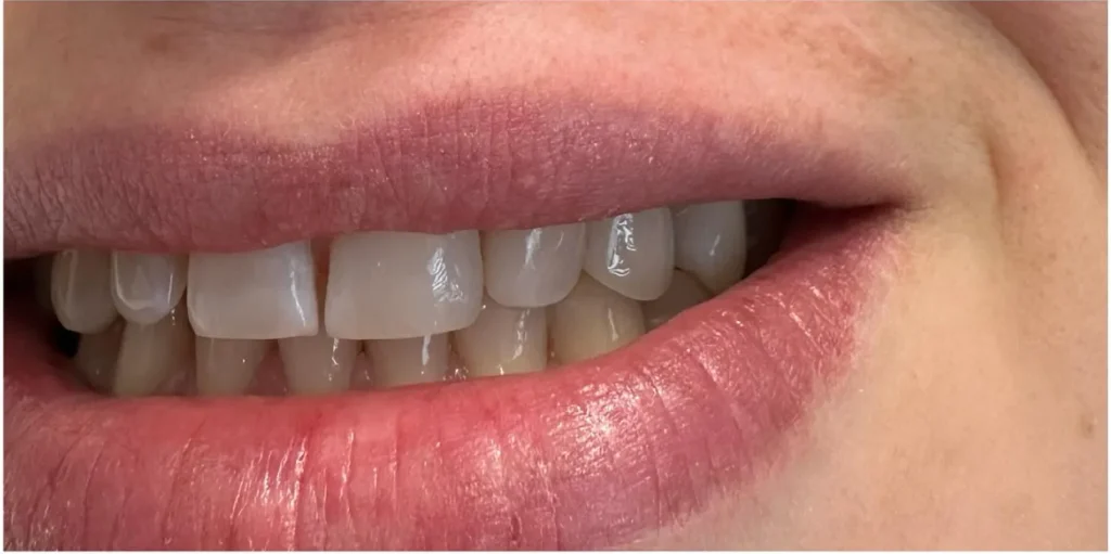 Closing gaps with composite bonding