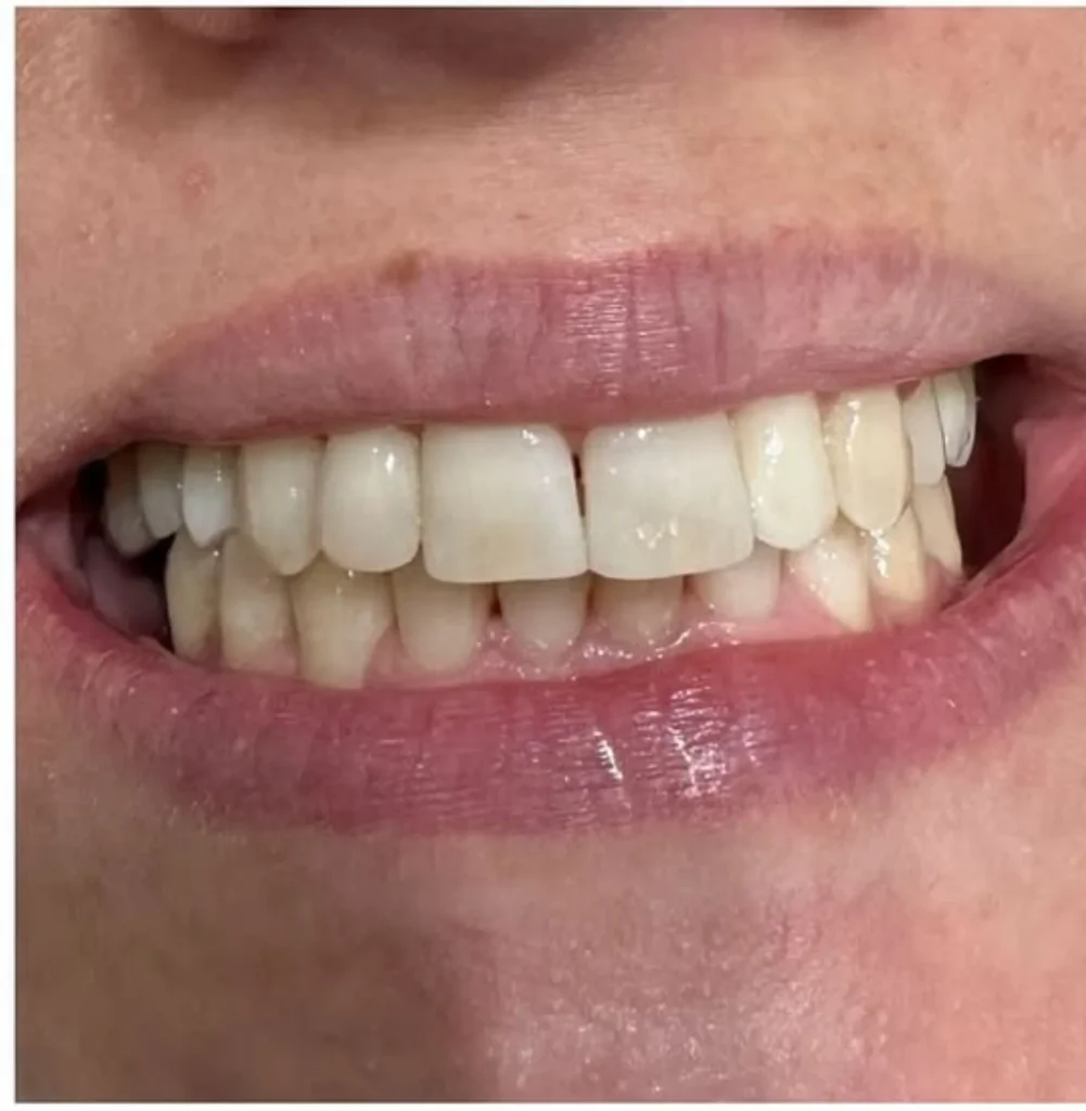 Orthodontic alignment, frontal view