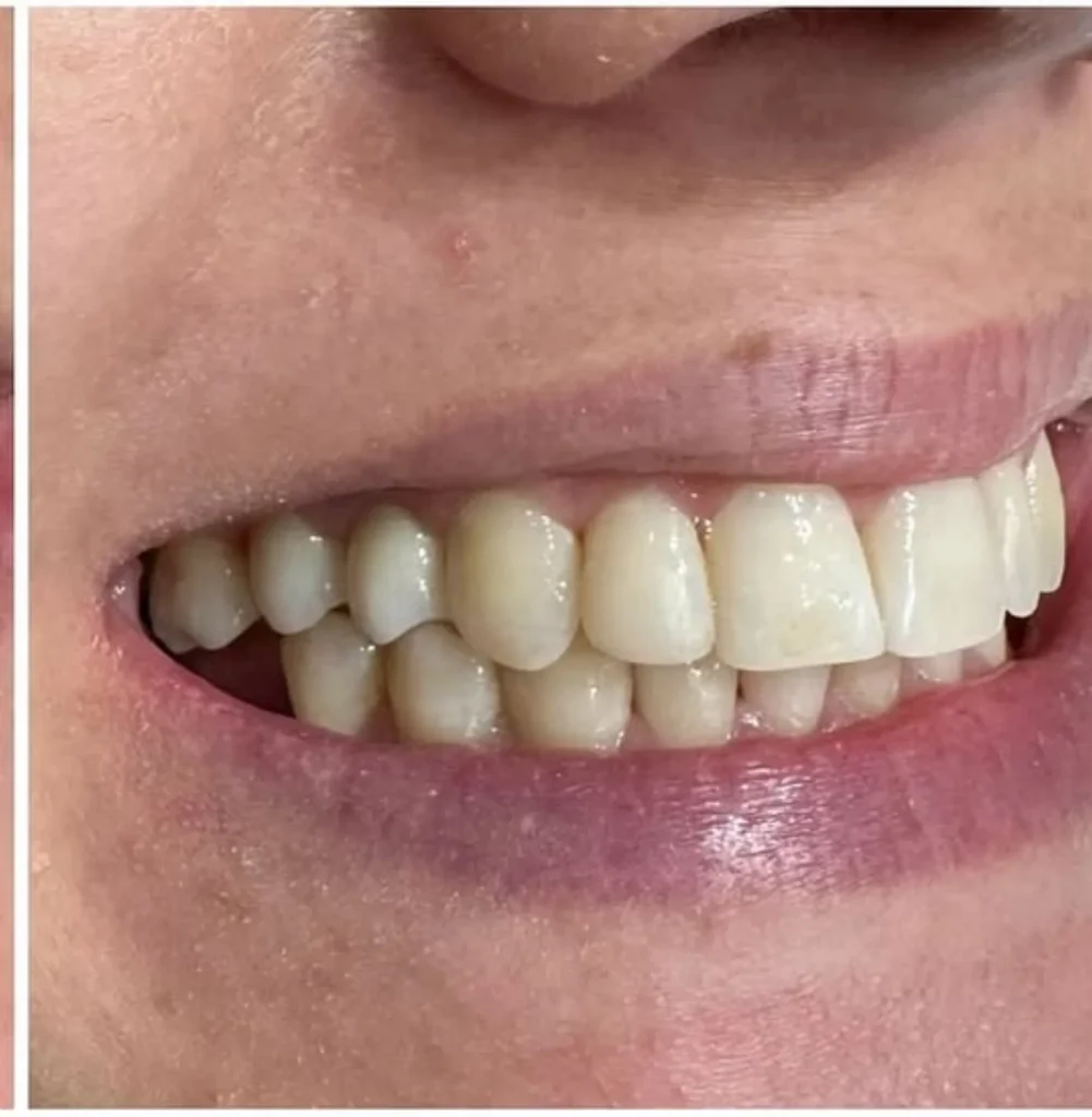 Orthodontic alignment, lateral view